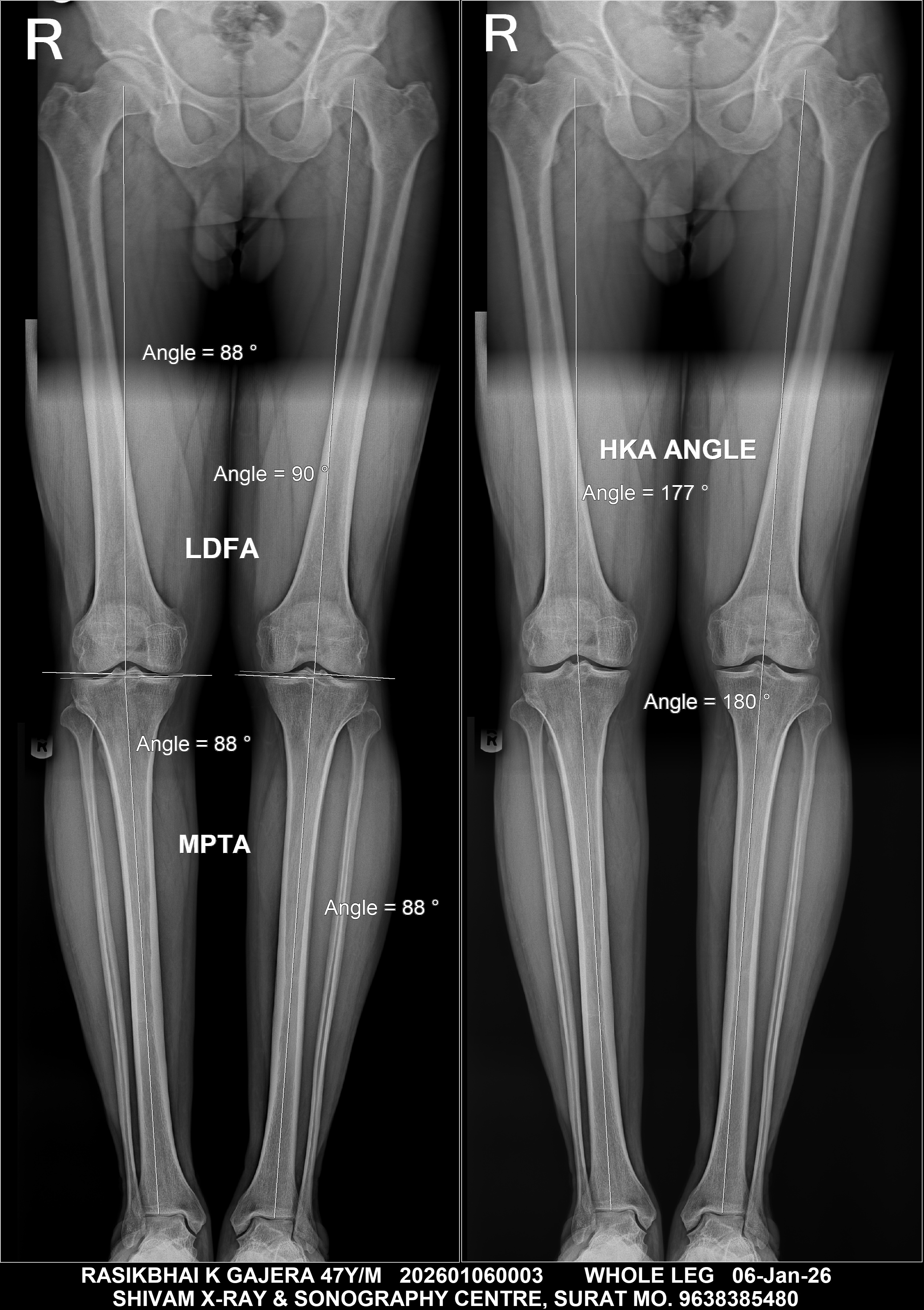 Sample X-Ray - Scanogram