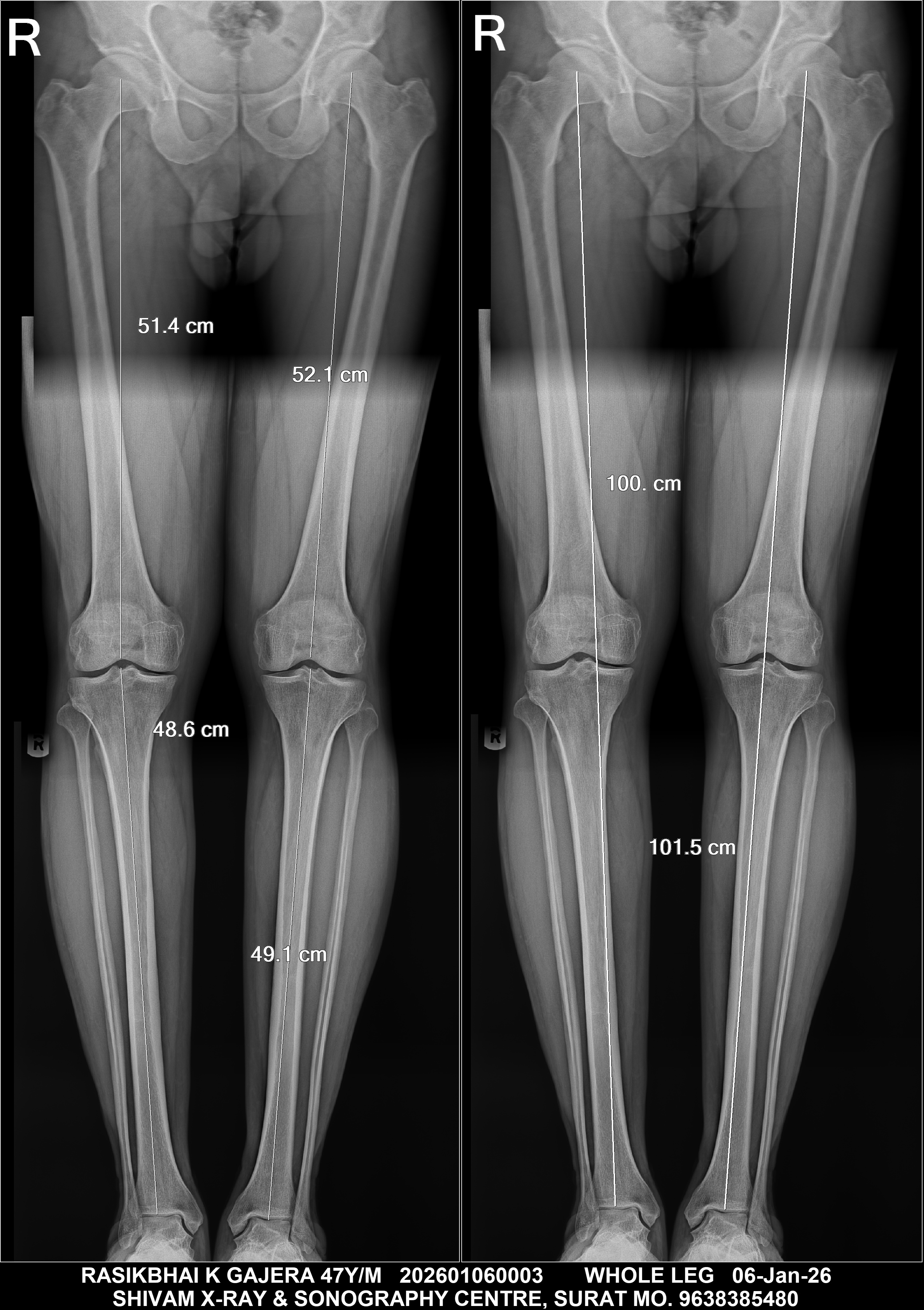 Sample X-Ray - Scanogram